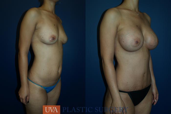 Breast Augmentation Case 20 Before & After View #3 | Richmond, Charlottesville & Roanoke, VA | University of Virginia Plastic Surgery