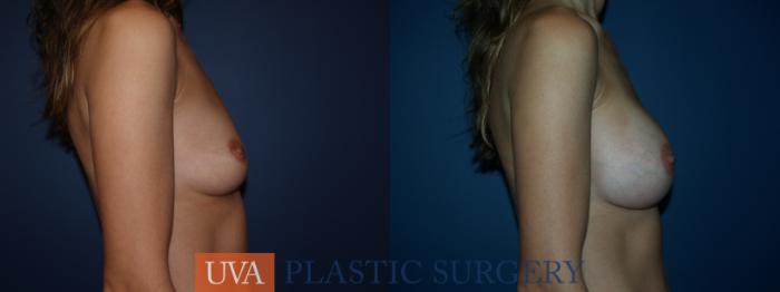 Breast Augmentation Case 27 Before & After View #4 | Richmond, Charlottesville & Roanoke, VA | University of Virginia Plastic Surgery