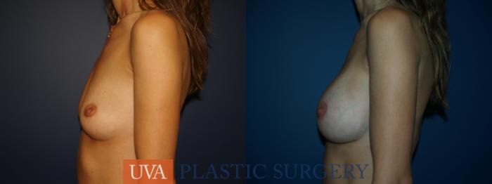 Breast Augmentation Case 27 Before & After View #5 | Richmond, Charlottesville & Roanoke, VA | University of Virginia Plastic Surgery