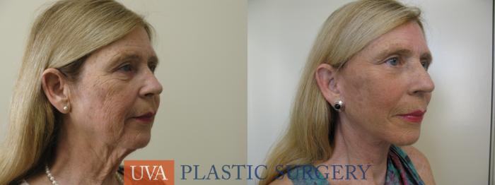 Necklift (Cervicoplasty) Case 80 Before & After View #2 | Richmond, Charlottesville & Roanoke, VA | University of Virginia Plastic Surgery