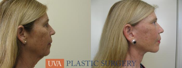 Necklift (Cervicoplasty) Case 80 Before & After View #3 | Richmond, Charlottesville & Roanoke, VA | University of Virginia Plastic Surgery