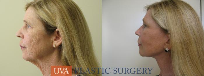 Necklift (Cervicoplasty) Case 80 Before & After View #5 | Richmond, Charlottesville & Roanoke, VA | University of Virginia Plastic Surgery