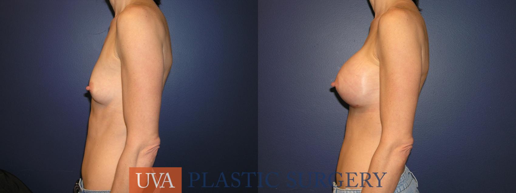 Breast Augmentation Case 1 Before & After View #1 | Charlottesville & Fishersville, VA | University of Virginia Plastic Surgery