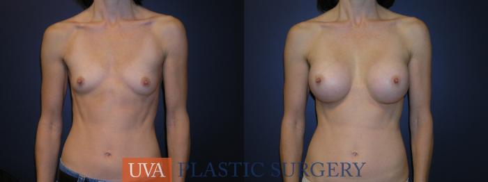 Breast Augmentation Case 1 Before & After View #2 | Richmond, Charlottesville & Roanoke, VA | University of Virginia Plastic Surgery