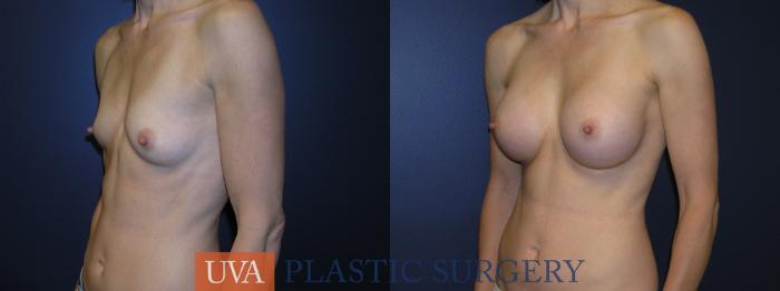 Breast Augmentation Case 1 Before & After View #3 | Richmond, Charlottesville & Roanoke, VA | University of Virginia Plastic Surgery