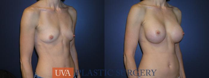 Breast Augmentation Case 1 Before & After View #4 | Richmond, Charlottesville & Roanoke, VA | University of Virginia Plastic Surgery
