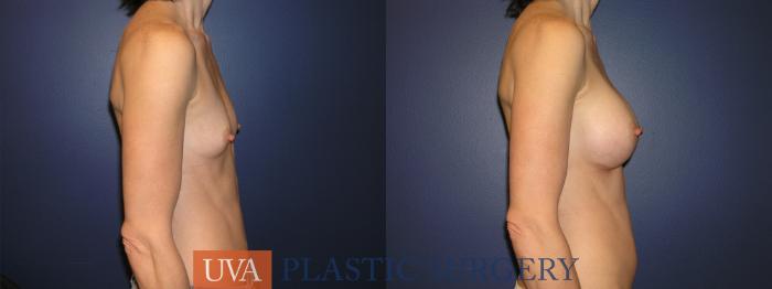 Breast Augmentation Case 1 Before & After View #5 | Richmond, Charlottesville & Roanoke, VA | University of Virginia Plastic Surgery