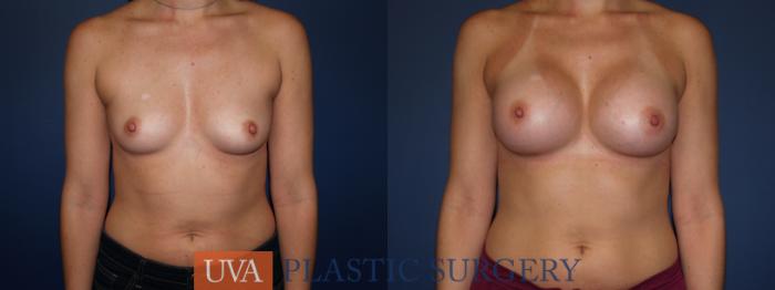 Breast Augmentation Case 103 Before & After View #1 | Richmond, Charlottesville & Roanoke, VA | University of Virginia Plastic Surgery