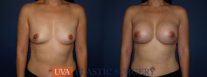 Breast Augmentation Case 106 Before & After View #1 | Richmond, Charlottesville & Roanoke, VA | University of Virginia Plastic Surgery