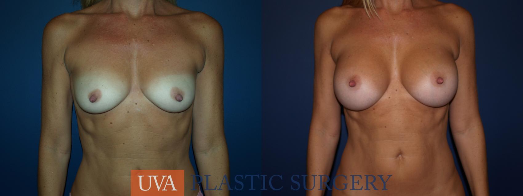 Breast Augmentation Case 107 Before & After View #1 | Charlottesville & Fishersville, VA | University of Virginia Plastic Surgery