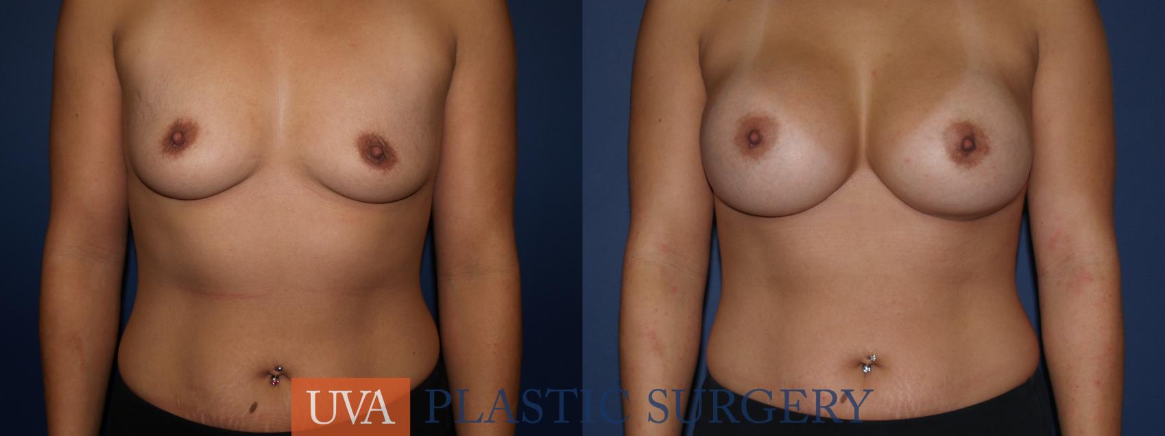 Breast Augmentation Case 110 Before & After View #1 | Charlottesville & Fishersville, VA | University of Virginia Plastic Surgery
