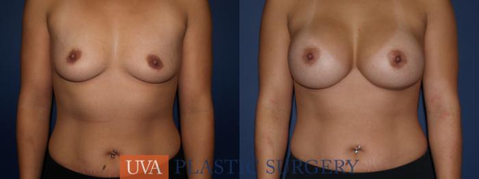 Breast Augmentation Case 110 Before & After View #1 | Richmond, Charlottesville & Roanoke, VA | University of Virginia Plastic Surgery