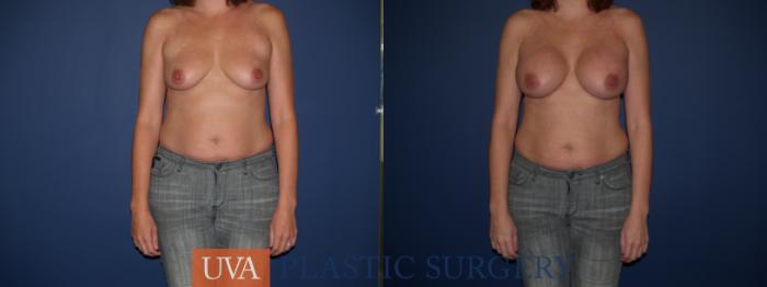 Breast Augmentation Case 121 Before & After View #1 | Richmond, Charlottesville & Roanoke, VA | University of Virginia Plastic Surgery