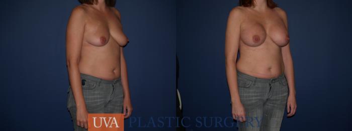 Breast Augmentation Case 121 Before & After View #2 | Richmond, Charlottesville & Roanoke, VA | University of Virginia Plastic Surgery