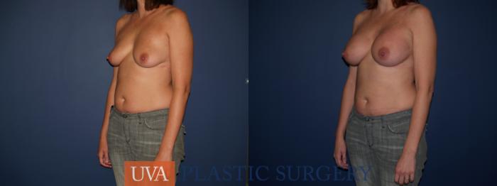 Breast Augmentation Case 121 Before & After View #3 | Richmond, Charlottesville & Roanoke, VA | University of Virginia Plastic Surgery