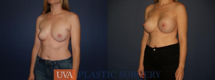 Breast Augmentation Case 122 Before & After View #2 | Richmond, Charlottesville & Roanoke, VA | University of Virginia Plastic Surgery
