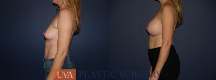 Breast Augmentation Case 122 Before & After View #3 | Richmond, Charlottesville & Roanoke, VA | University of Virginia Plastic Surgery