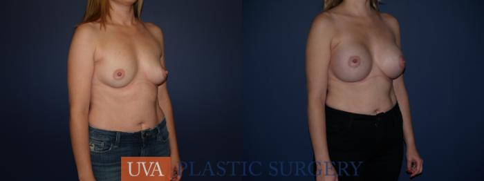 Breast Augmentation Case 122 Before & After View #4 | Richmond, Charlottesville & Roanoke, VA | University of Virginia Plastic Surgery