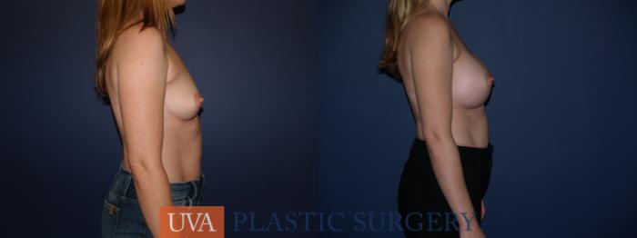 Breast Augmentation Case 122 Before & After View #5 | Richmond, Charlottesville & Roanoke, VA | University of Virginia Plastic Surgery