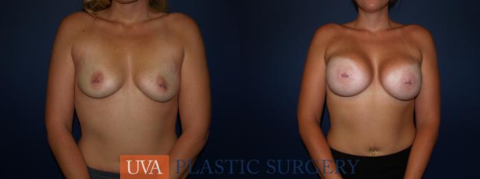 Breast Augmentation Case 123 Before & After View #1 | Richmond, Charlottesville & Roanoke, VA | University of Virginia Plastic Surgery