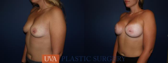 Breast Augmentation Case 123 Before & After View #2 | Richmond, Charlottesville & Roanoke, VA | University of Virginia Plastic Surgery