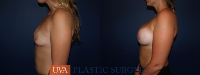 Breast Augmentation Case 123 Before & After View #3 | Richmond, Charlottesville & Roanoke, VA | University of Virginia Plastic Surgery