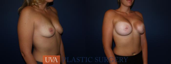 Breast Augmentation Case 123 Before & After View #4 | Richmond, Charlottesville & Roanoke, VA | University of Virginia Plastic Surgery