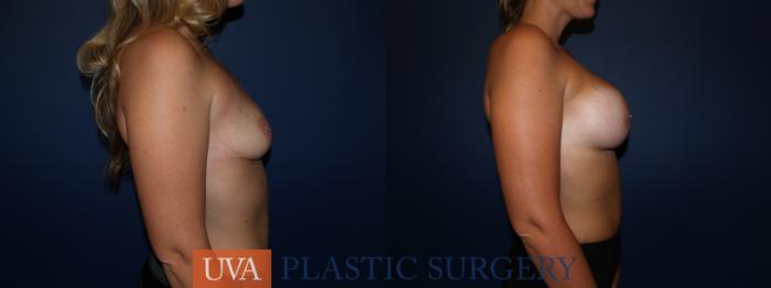 Breast Augmentation Case 123 Before & After View #5 | Richmond, Charlottesville & Roanoke, VA | University of Virginia Plastic Surgery