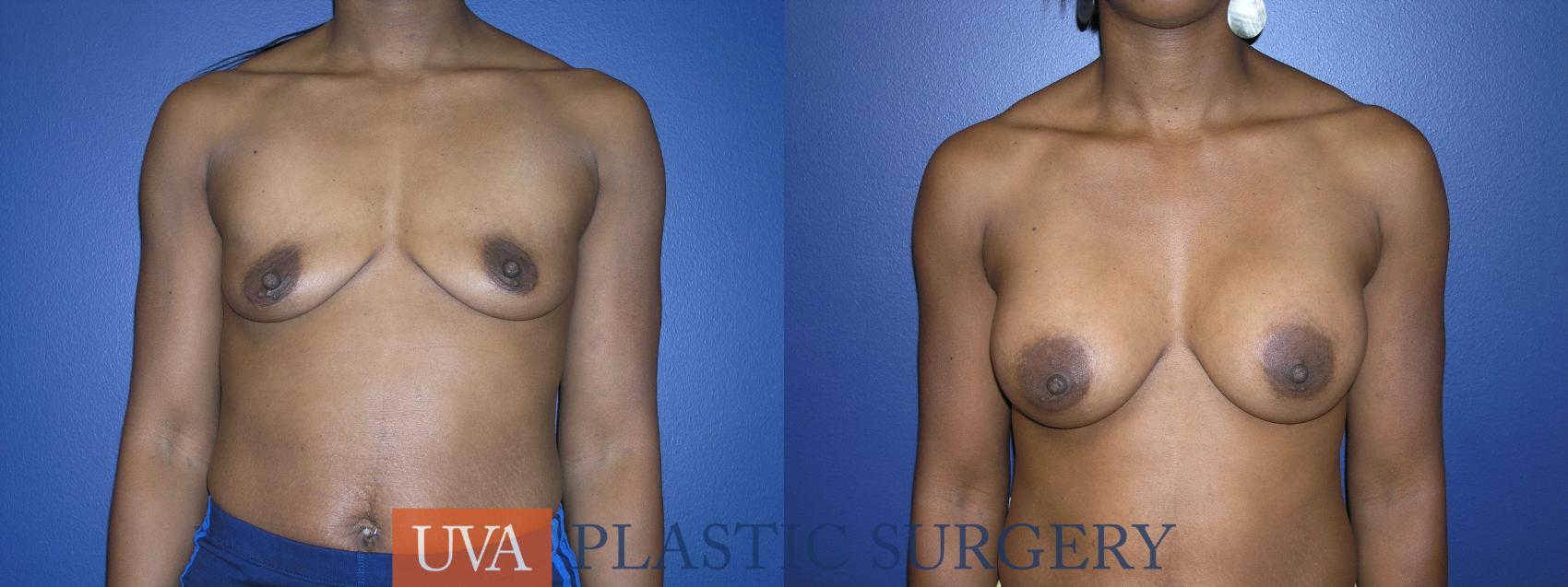 Breast Augmentation Case 13 Before & After View #1 | Charlottesville & Fishersville, VA | University of Virginia Plastic Surgery