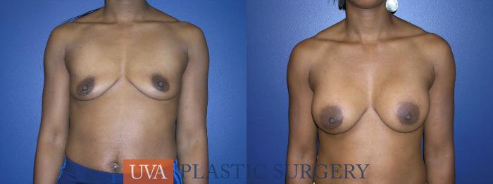 Breast Augmentation Case 13 Before & After View #1 | Richmond, Charlottesville & Roanoke, VA | University of Virginia Plastic Surgery