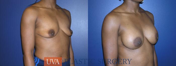 Breast Augmentation Case 13 Before & After View #2 | Richmond, Charlottesville & Roanoke, VA | University of Virginia Plastic Surgery