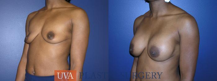 Breast Augmentation Case 13 Before & After View #3 | Richmond, Charlottesville & Roanoke, VA | University of Virginia Plastic Surgery