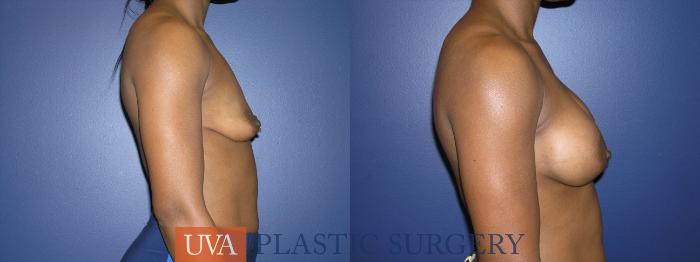 Breast Augmentation Case 13 Before & After View #4 | Richmond, Charlottesville & Roanoke, VA | University of Virginia Plastic Surgery