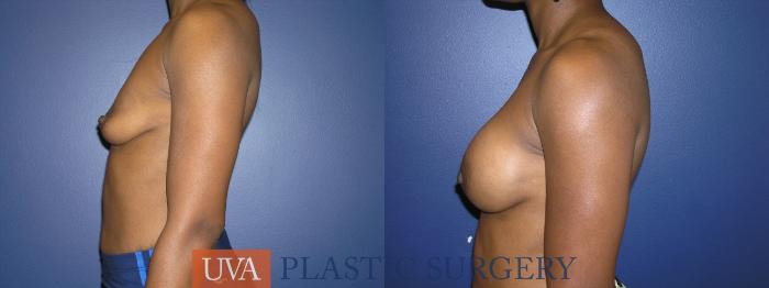 Breast Augmentation Case 13 Before & After View #5 | Richmond, Charlottesville & Roanoke, VA | University of Virginia Plastic Surgery