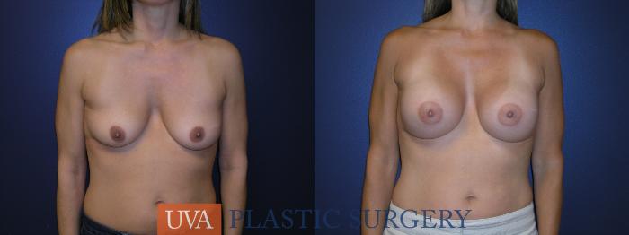 Breast Augmentation Case 14 Before & After View #1 | Richmond, Charlottesville & Roanoke, VA | University of Virginia Plastic Surgery