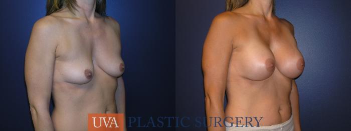 Breast Augmentation Case 14 Before & After View #2 | Richmond, Charlottesville & Roanoke, VA | University of Virginia Plastic Surgery
