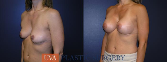 Breast Augmentation Case 14 Before & After View #3 | Richmond, Charlottesville & Roanoke, VA | University of Virginia Plastic Surgery
