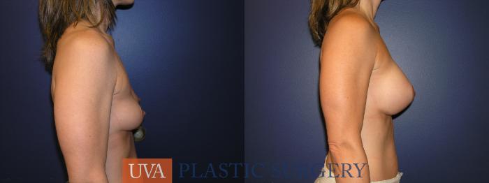 Breast Augmentation Case 14 Before & After View #4 | Richmond, Charlottesville & Roanoke, VA | University of Virginia Plastic Surgery
