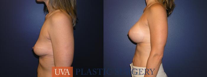 Breast Augmentation Case 14 Before & After View #5 | Richmond, Charlottesville & Roanoke, VA | University of Virginia Plastic Surgery