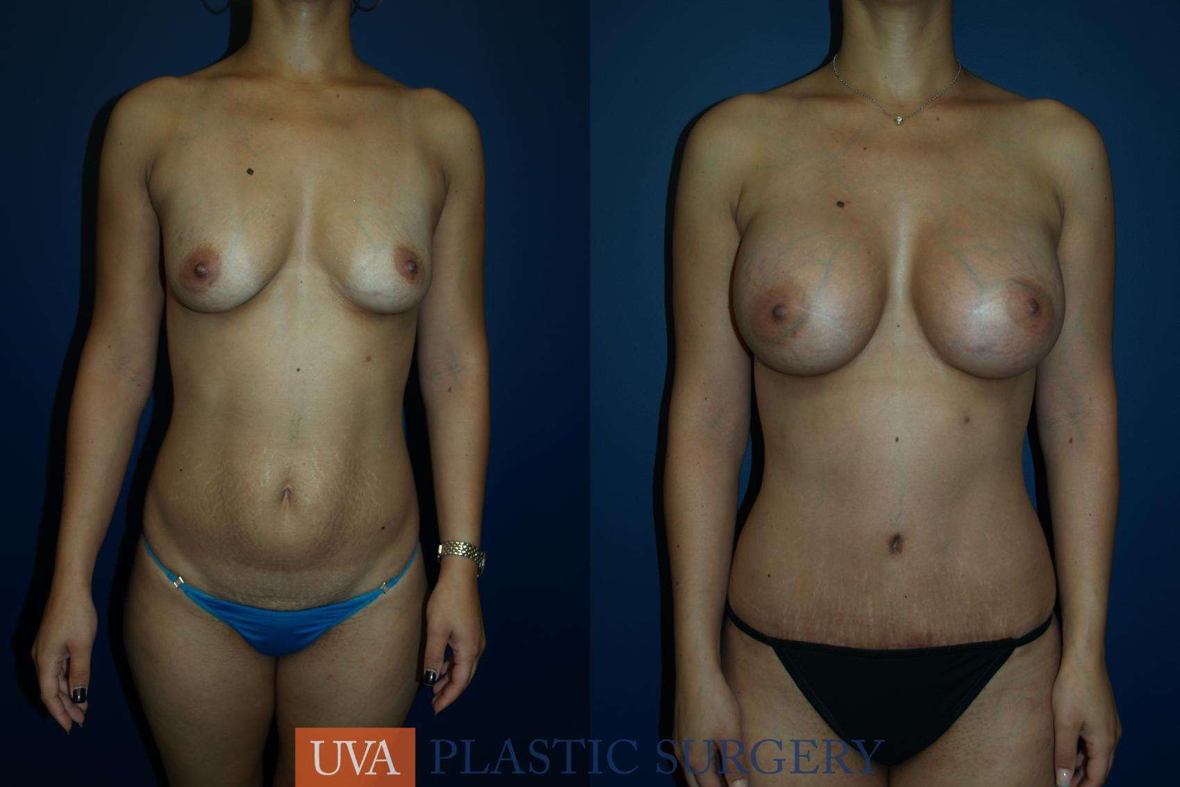 Breast Augmentation Case 20 Before & After View #1 | Charlottesville & Fishersville, VA | University of Virginia Plastic Surgery