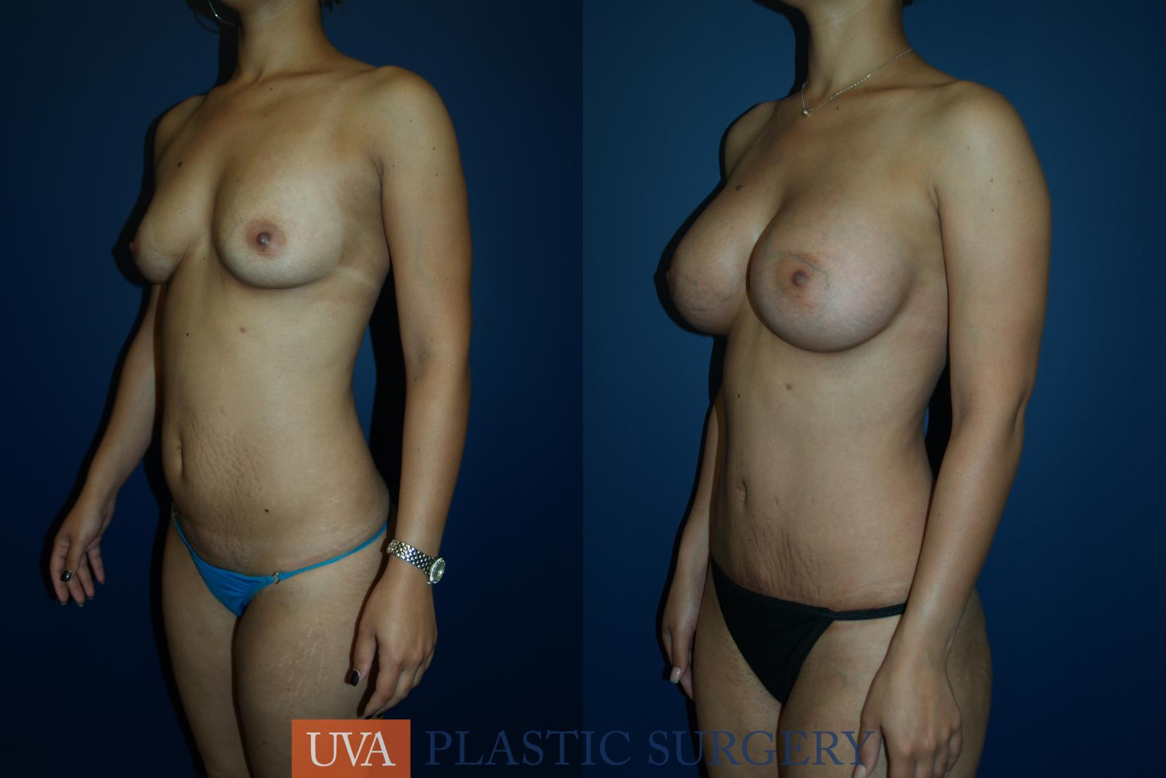 Breast Augmentation Case 20 Before & After View #2 | Charlottesville & Fishersville, VA | University of Virginia Plastic Surgery