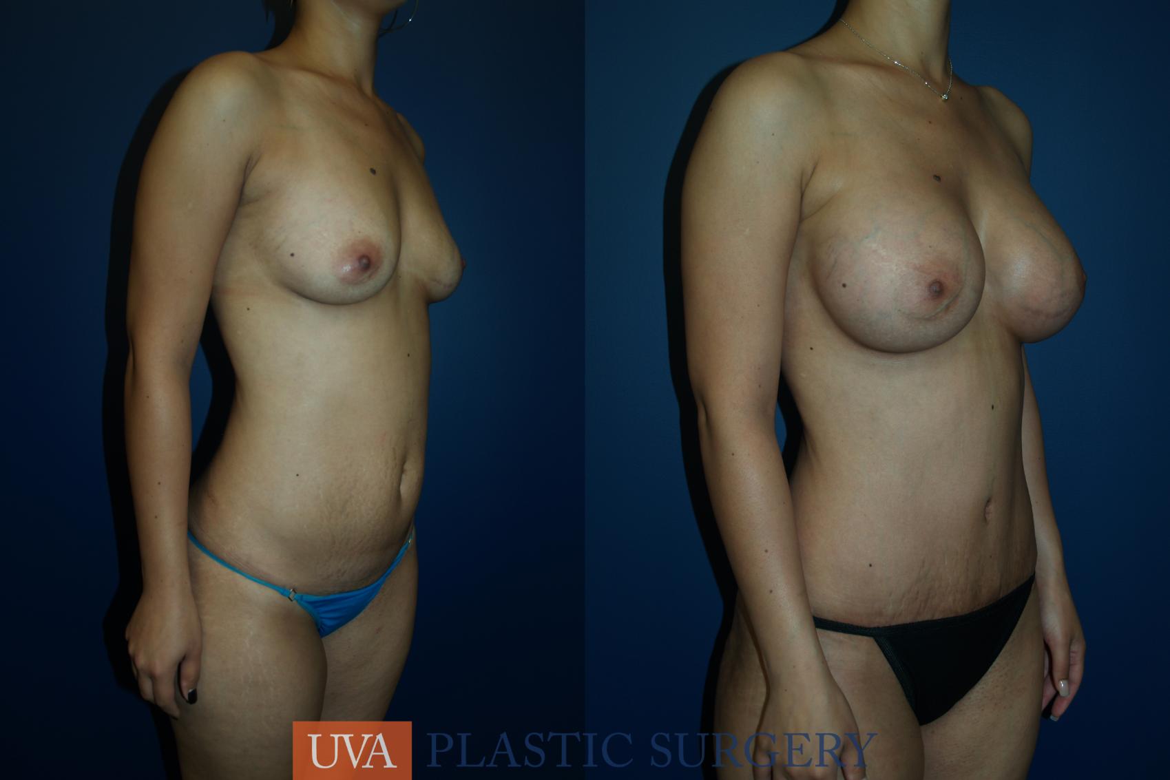 Breast Augmentation Case 20 Before & After View #3 | Charlottesville & Fishersville, VA | University of Virginia Plastic Surgery