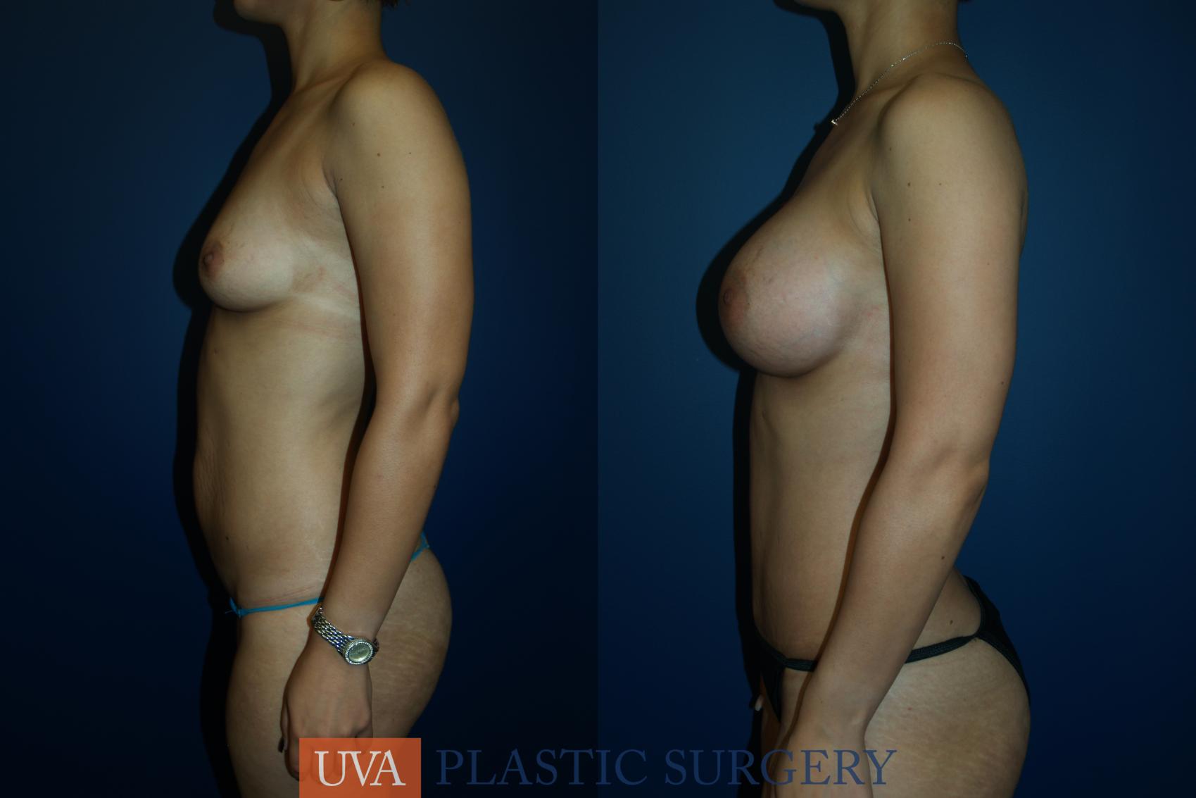 Breast Augmentation Case 20 Before & After View #4 | Charlottesville & Fishersville, VA | University of Virginia Plastic Surgery