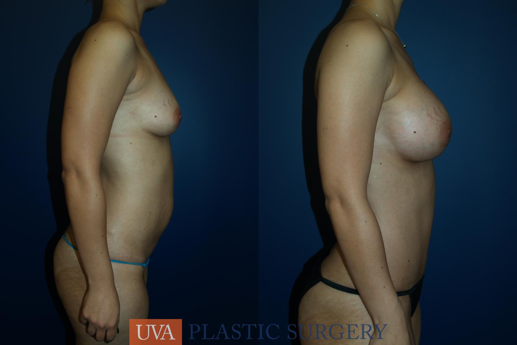 Breast Augmentation Case 20 Before & After View #5 | Charlottesville & Fishersville, VA | University of Virginia Plastic Surgery