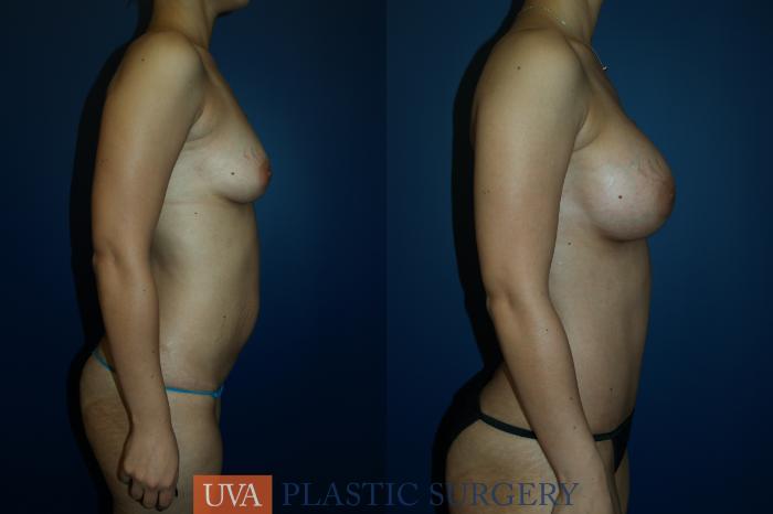 Breast Augmentation Case 20 Before & After View #5 | Richmond, Charlottesville & Roanoke, VA | University of Virginia Plastic Surgery