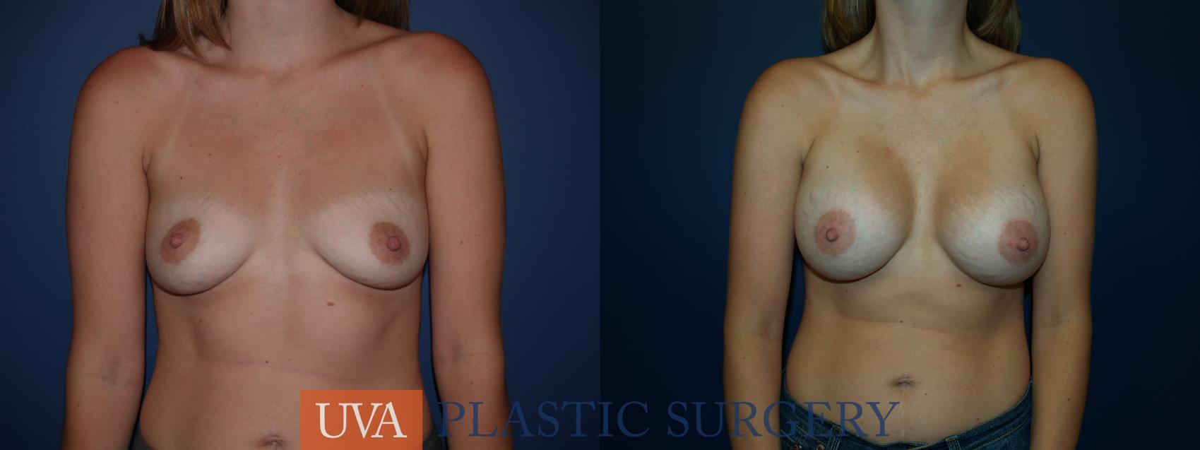 Breast Augmentation Case 21 Before & After View #1 | Charlottesville & Fishersville, VA | University of Virginia Plastic Surgery