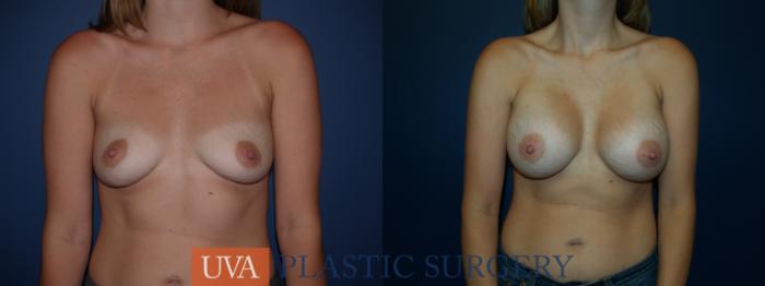 Breast Augmentation Case 21 Before & After View #1 | Richmond, Charlottesville & Roanoke, VA | University of Virginia Plastic Surgery