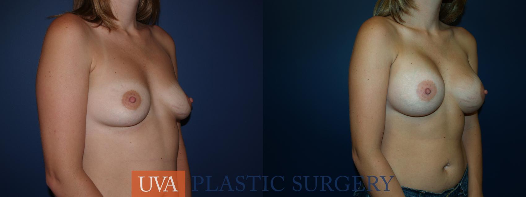Breast Augmentation Case 21 Before & After View #2 | Charlottesville & Fishersville, VA | University of Virginia Plastic Surgery
