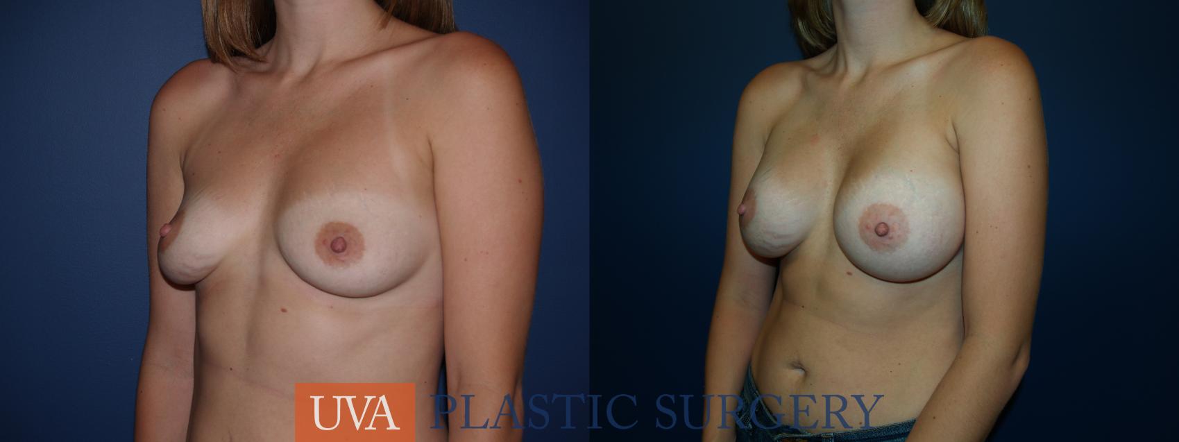 Breast Augmentation Case 21 Before & After View #3 | Charlottesville & Fishersville, VA | University of Virginia Plastic Surgery