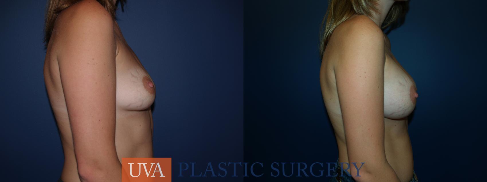 Breast Augmentation Case 21 Before & After View #4 | Charlottesville & Fishersville, VA | University of Virginia Plastic Surgery